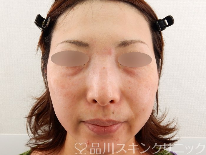 症例NO.63640のAFTER写真