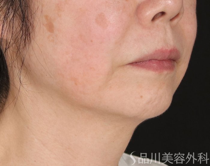 症例NO.73639のBEFORE写真