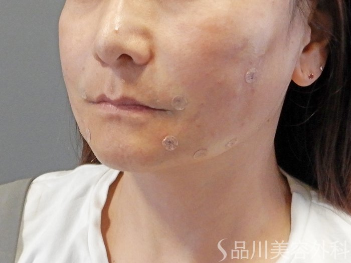 症例NO.65187のAFTER写真