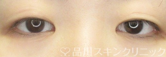 症例NO.69291のBEFORE写真