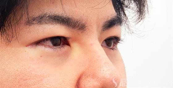 症例NO.53018のAFTER写真