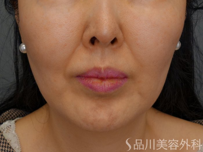 症例NO.73688のBEFORE写真