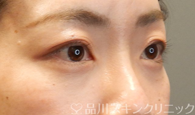 症例NO.68333のAFTER写真