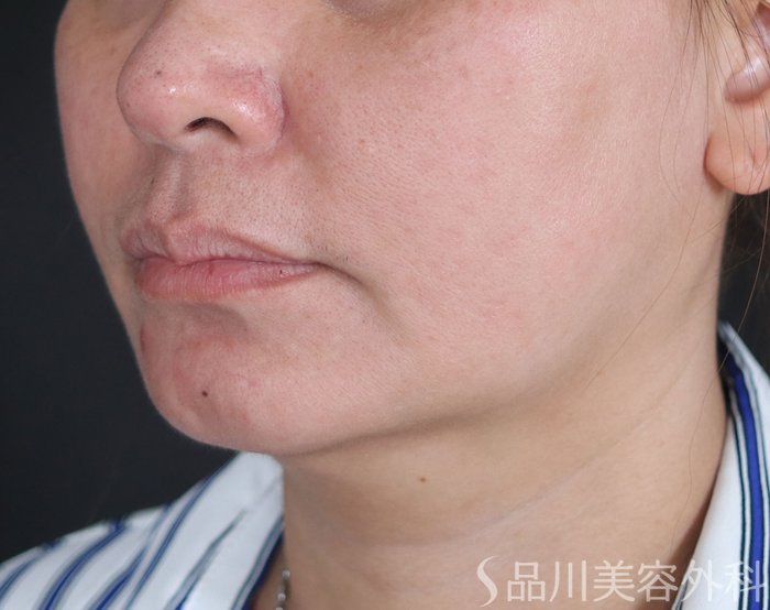 症例NO.73778のBEFORE写真