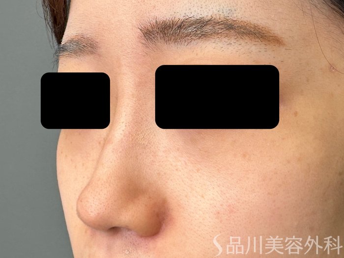 症例NO.74882のBEFORE写真