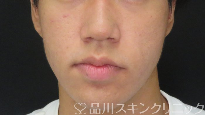 症例NO.71852のAFTER写真