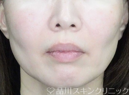 症例NO.63604のBEFORE写真