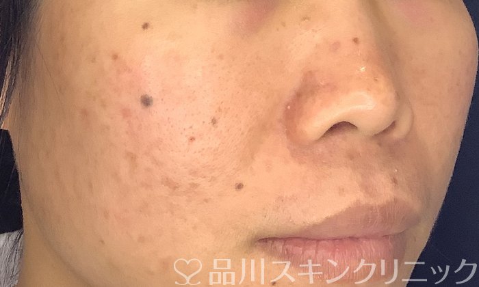 症例NO.72805のBEFORE写真