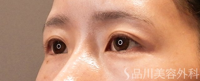 症例NO.70551のBEFORE写真
