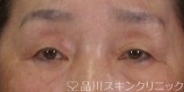症例NO.74735のBEFORE写真