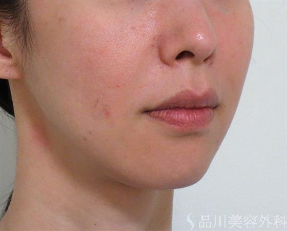 症例NO.38653のBEFORE写真