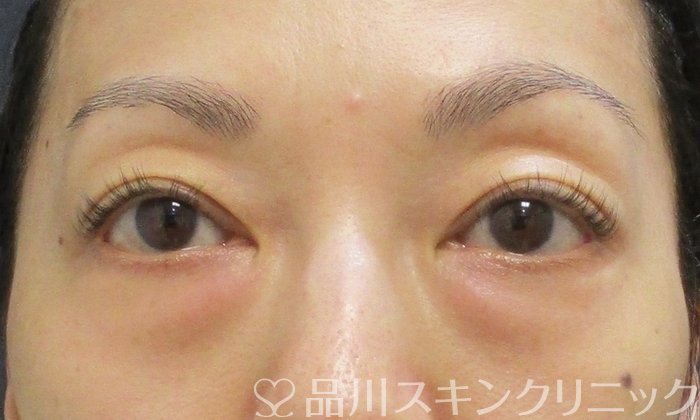 症例NO.70407のBEFORE写真