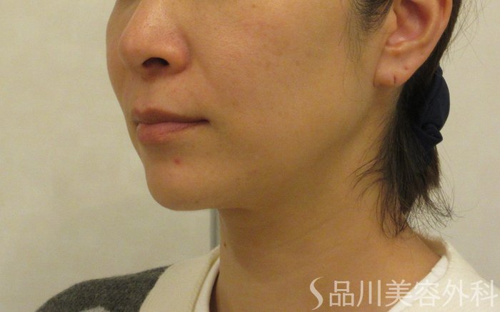 症例NO.72427のBEFORE写真