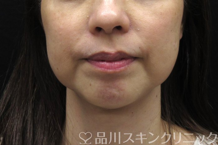 症例NO.74440のBEFORE写真