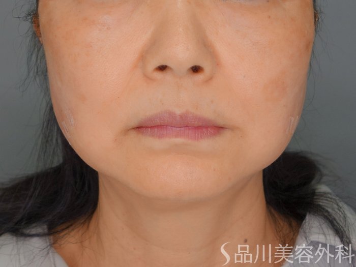 症例NO.73188のAFTER写真