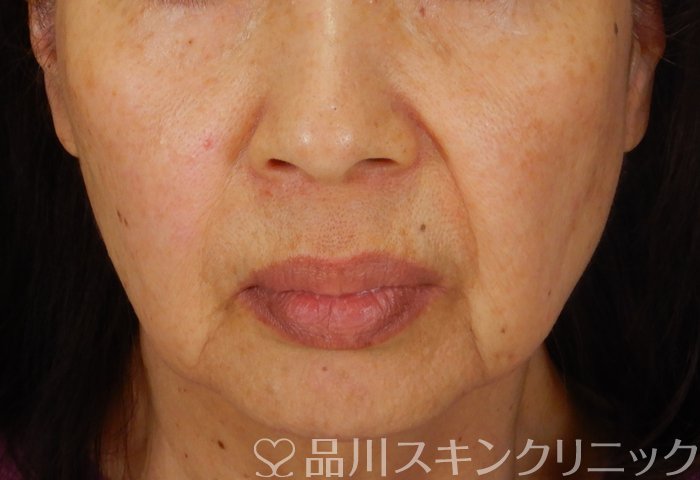 症例NO.65135のBEFORE写真