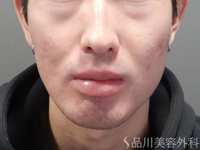 症例NO.72298のAFTER写真