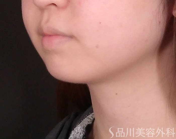 症例NO.69795のBEFORE写真