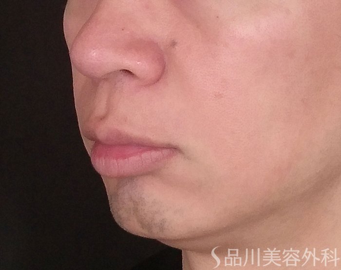 症例NO.71385のBEFORE写真
