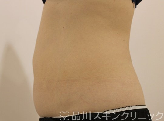 症例NO.69595のAFTER写真