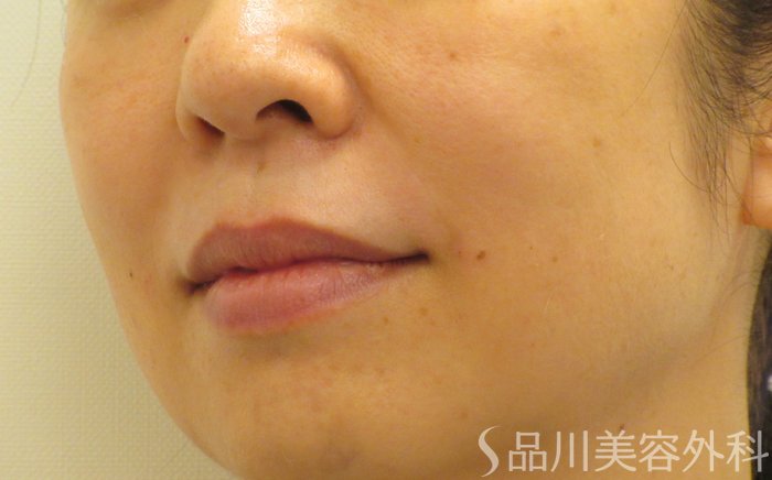 症例NO.70395のAFTER写真