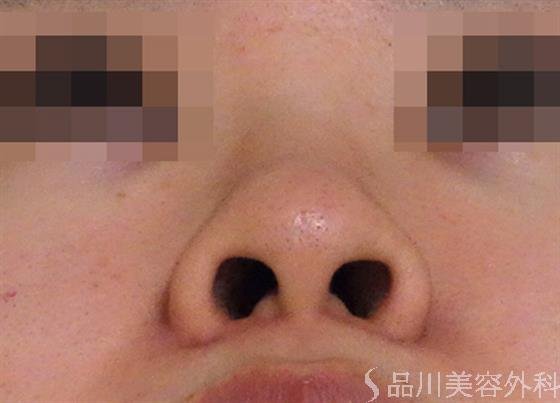 症例NO.37460のBEFORE写真