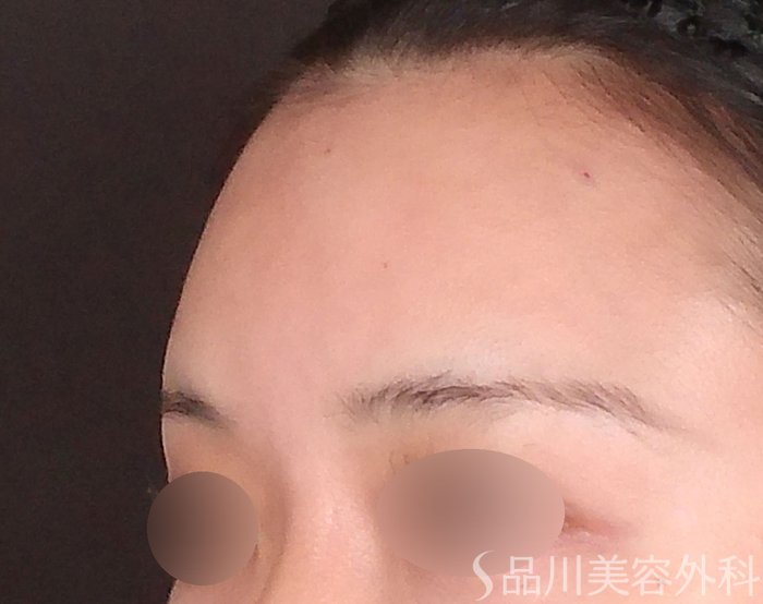 症例NO.70695のAFTER写真