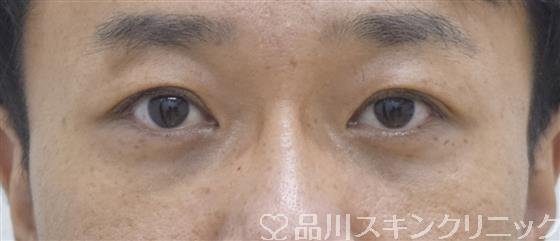 症例NO.52925のAFTER写真
