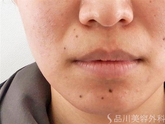 症例NO.61254のBEFORE写真