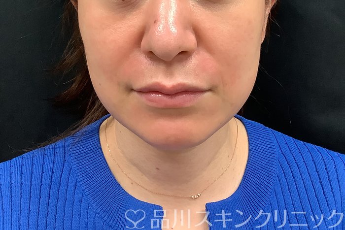 症例NO.71277のAFTER写真