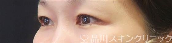 症例NO.61948のBEFORE写真