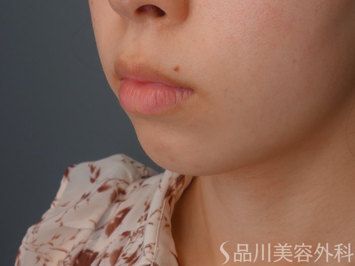 症例NO.63144のBEFORE写真