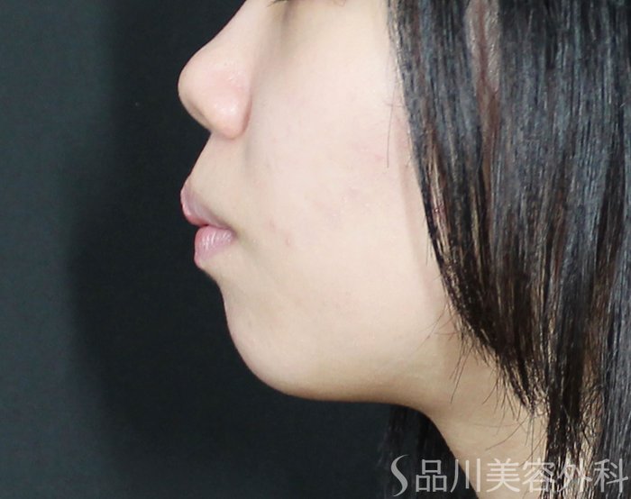 症例NO.72509のBEFORE写真