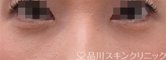 症例NO.36707のAFTER写真
