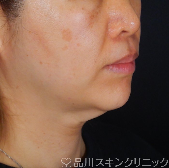 症例NO.65906のBEFORE写真
