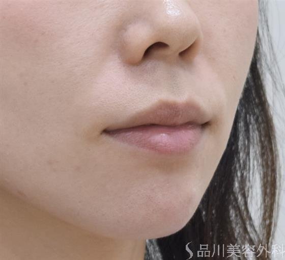 症例NO.44114のAFTER写真