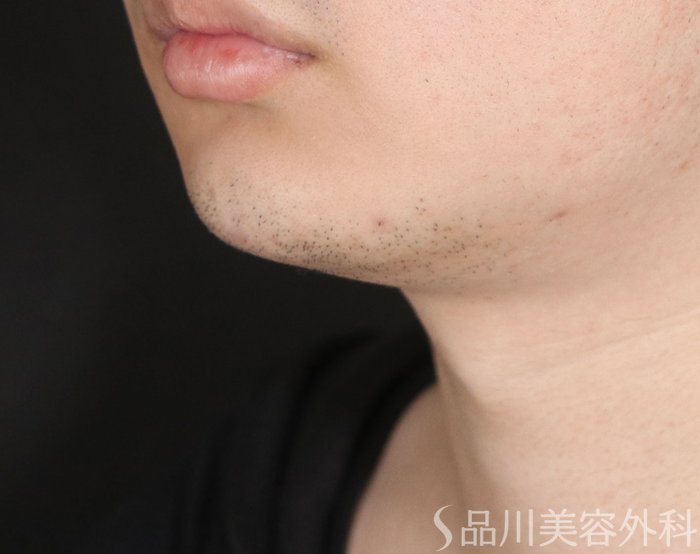 症例NO.72728のAFTER写真