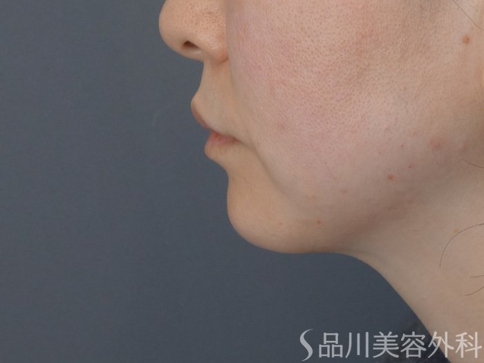 症例NO.72611のAFTER写真