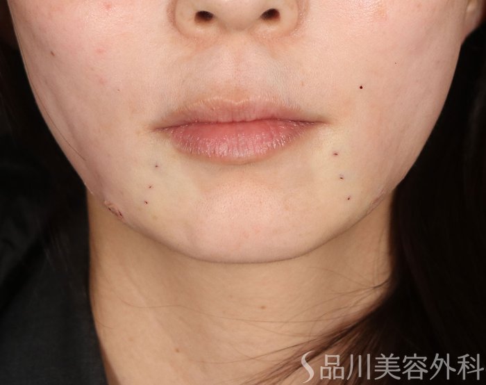 症例NO.72713のAFTER写真