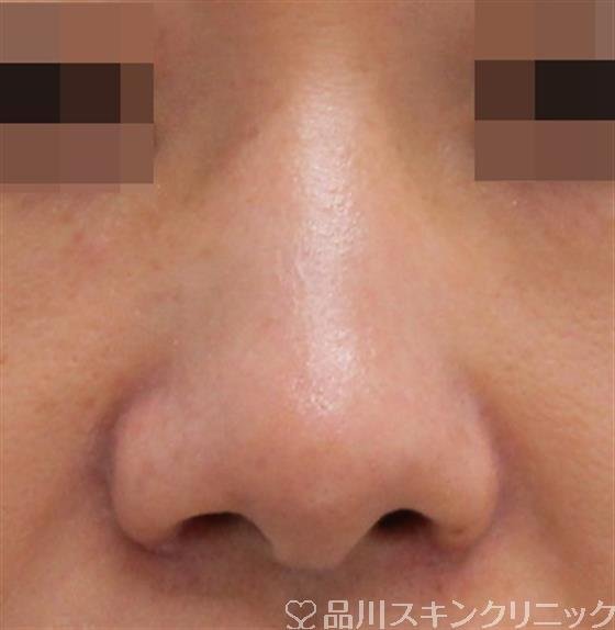 症例NO.38476のAFTER写真