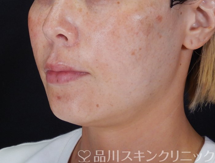 症例NO.66497のBEFORE写真