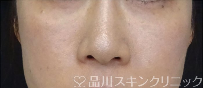 症例NO.69903のBEFORE写真