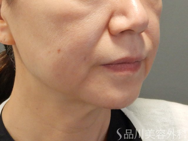 症例NO.72211のBEFORE写真