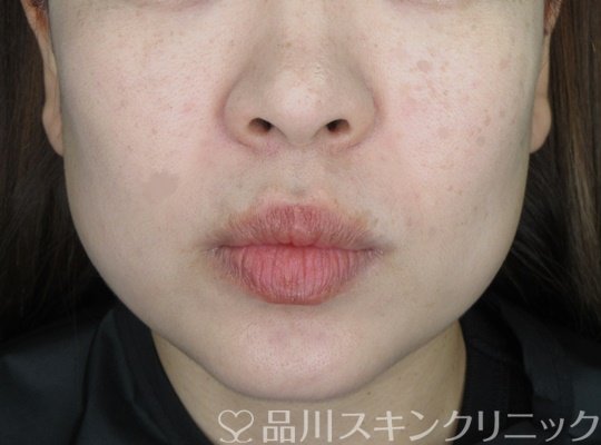 症例NO.69785のBEFORE写真