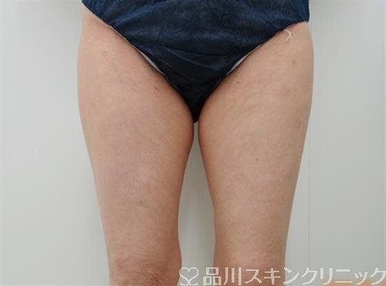症例NO.25653のAFTER写真