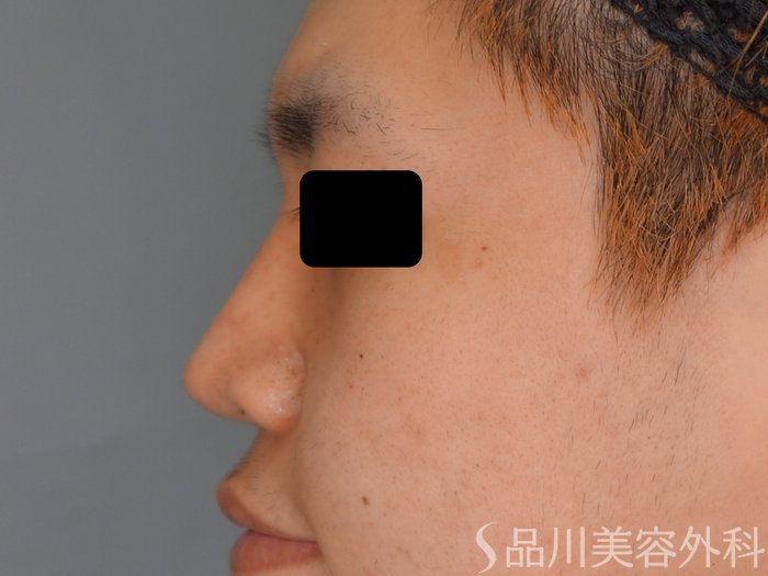症例NO.75050のAFTER写真