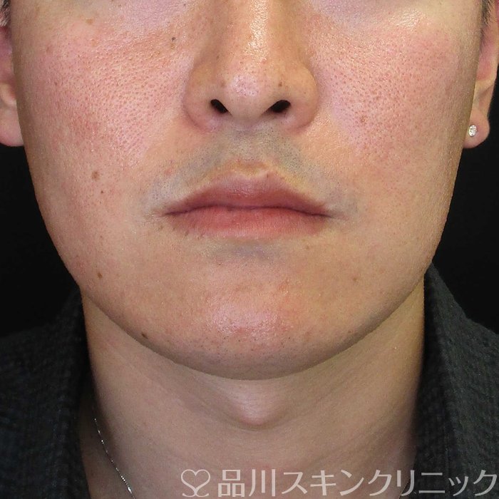 症例NO.67739のBEFORE写真