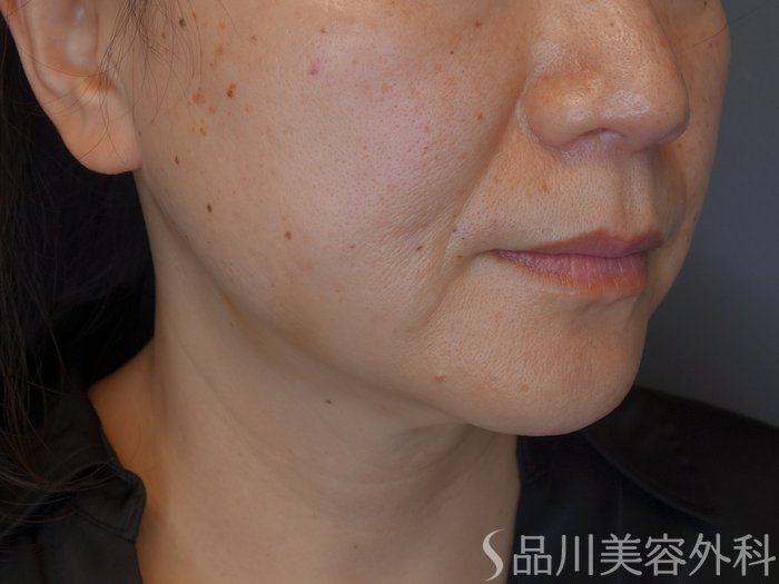 症例NO.67913のBEFORE写真