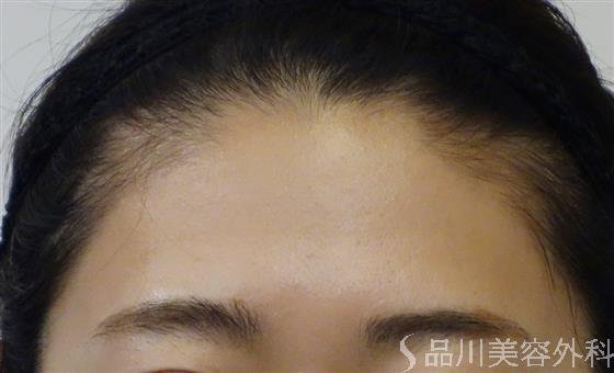 症例NO.48424のBEFORE写真