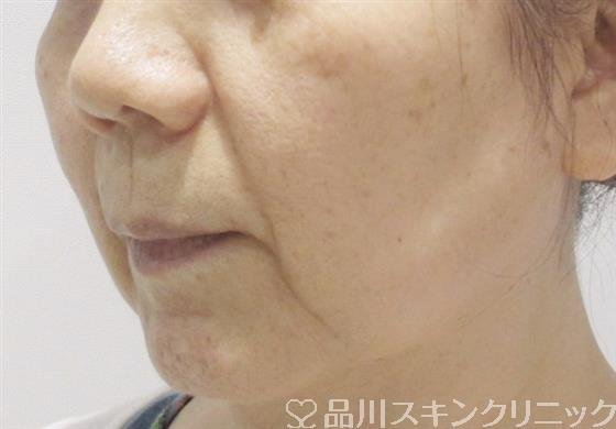 症例NO.36794のBEFORE写真